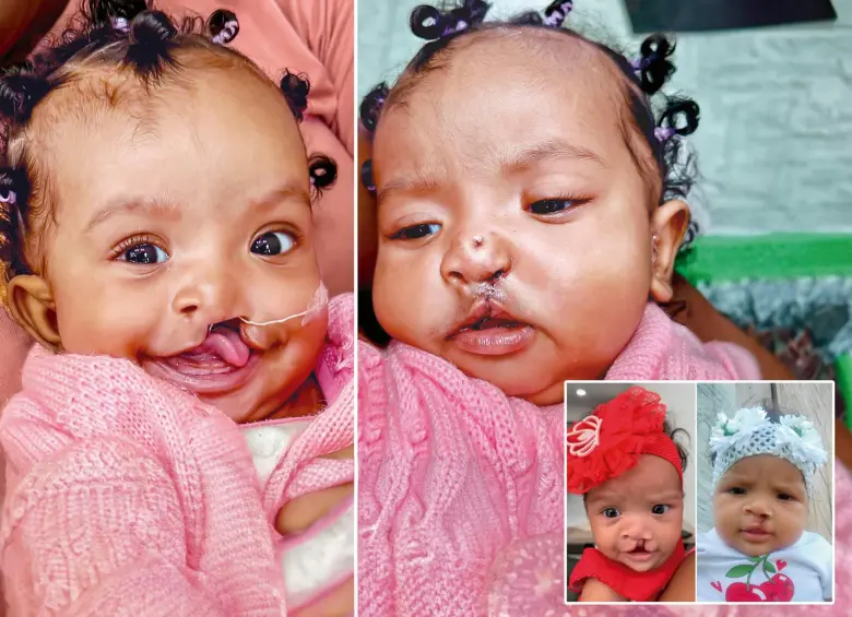 El efecto mágico de poder sonreír: termina misión para operar a 100 niños con labios y encía fisurada en Medellín