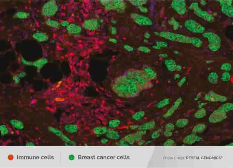 Células inmunes interaccionando con el cáncer de mama. FOTO cortesía Reveal Genomics