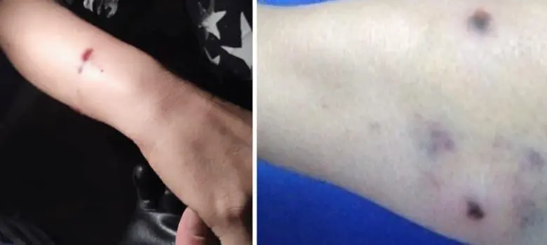 Primeros planos de heridas causadas por rifle de aire comprimido en brazo y pantorrilla, con hematomas y marcas de entrada de proyectiles. Foto: Cortesía.