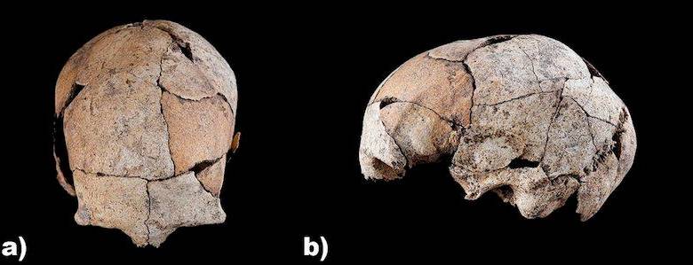 La cirugía fue sin anestesia y se realizó hace 6.000 años. Foto: Science Reports.