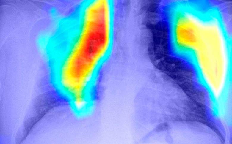 El método de Inbionic muestra la afectación del pulmón por la covid-19 utilizando radiografías de tórax. FOTO cortesía inbionic