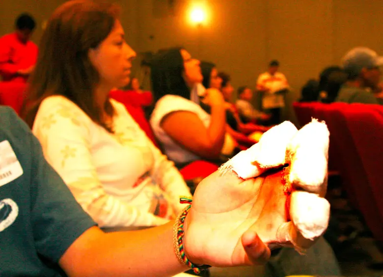 Las manos son la extremidad más afectada por la manipulación de pólvora en Antioquia, con 13 casos. FOTO: ARCHIVO