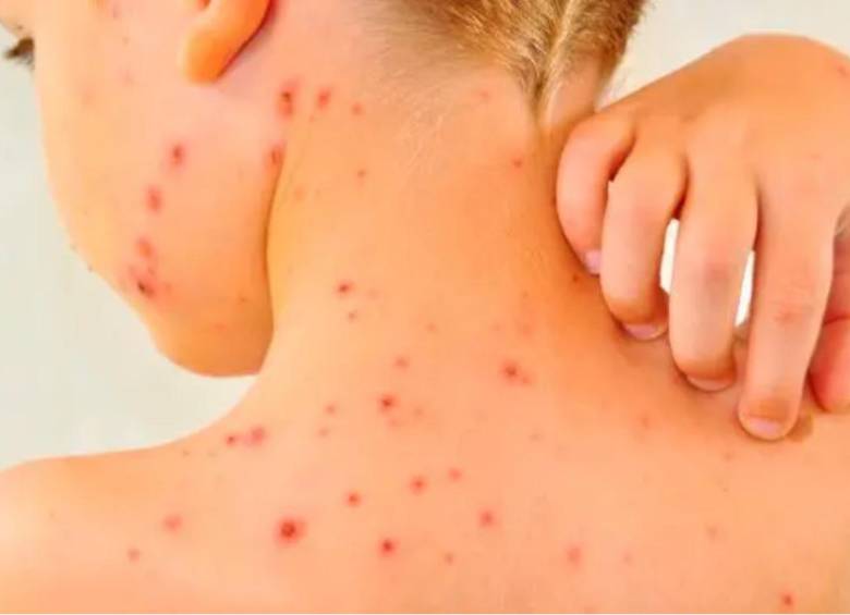 El equipo epidemiológico de la Secretaría de Salud de Bello mantendrá por lo menos tres semanas más la vigilancia hasta que no haya un solo caso de varicela. IMAGEN ILUSTRATIVA.