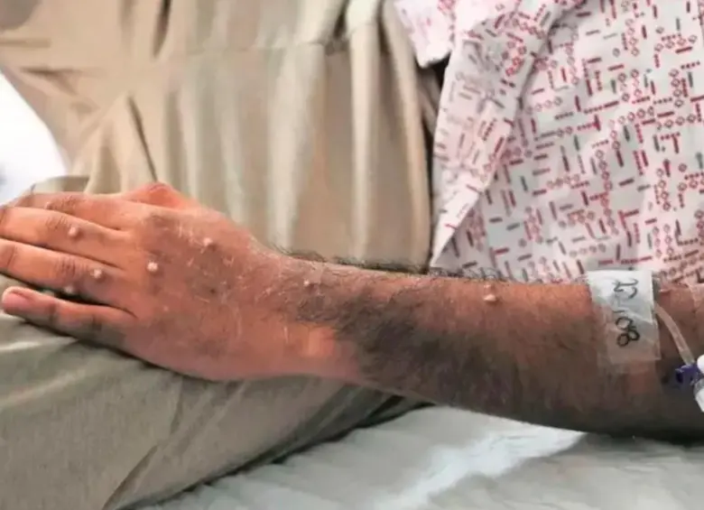 Las llagas aparecen entre uno y cinco días después de los primeros síntomas. FOTO CORTESÍA OMS.