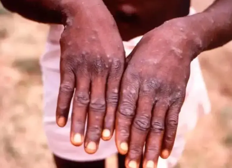 Las llagas aparecen entre uno o cinco días después de los primeros síntomas. FOTO GETTY.
