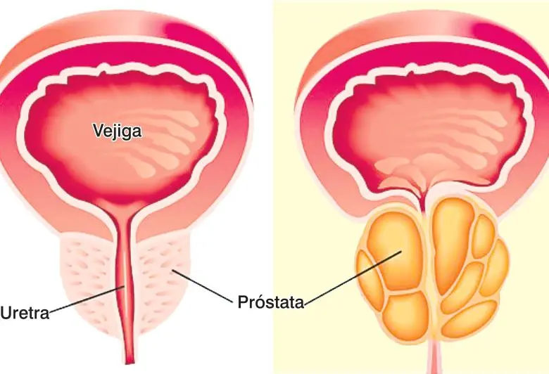 Detectar a tiempo el cáncer de próstata es vital