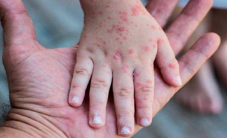 El Ministerio de Salud reportó que se mantiene el registro de cinco personas contagiadas con la viruela del mono en el territorio nacional. FOTO EFE