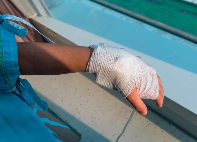 Las manos son la extremidad más afectada por la manipulación de pólvora en Antioquia, con 13 casos. FOTO: GETTY