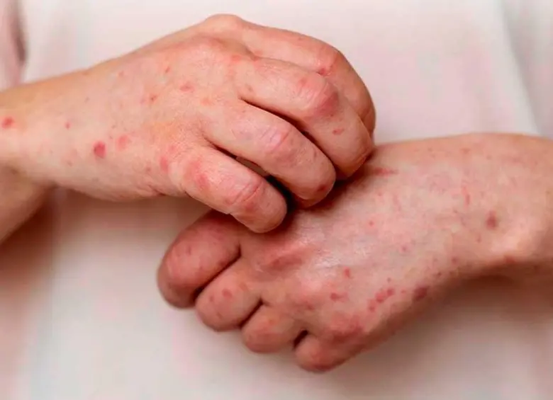 Casos de mpox variante clado Ib en Colombia. Foto: cortesía Prensa Latina
