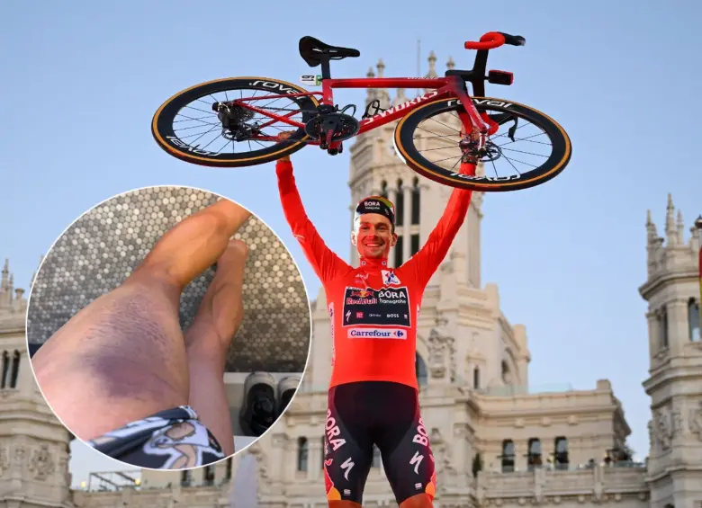 El ciclista esloveno cuatro veces ganador de La Vuelta a España, Primoz Roglic, mostró cómo quedó su pierna tras ser atropellado en Austria. Fotos: Getty Images y primozroglic