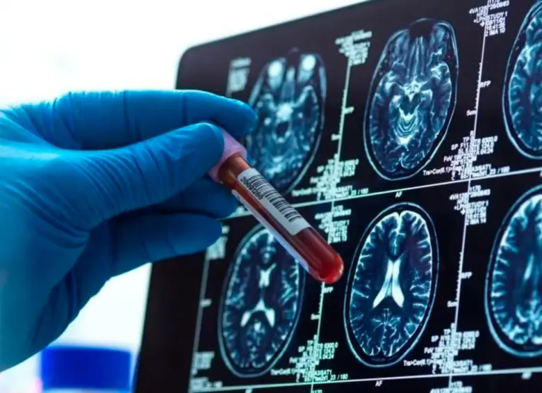 Según estimaciones, en el mundo hay alrededor de 57 millones de pacientes con Alzheimer. Los tratamientos todavía son materia de estudio. FOTO: Getty