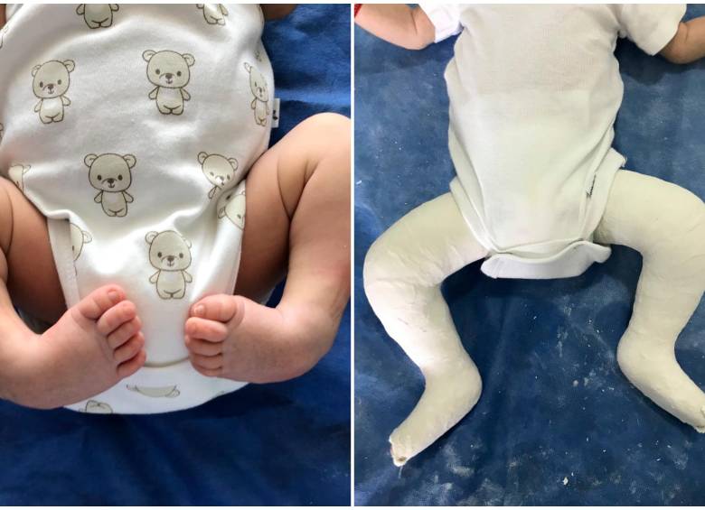 A la izquierda, un recién nacido con pie equinovaro; a la derecha, un niño con la férula utilizada en el tratamiento Ponseti. FOTOS cortesía Clínica Foscal