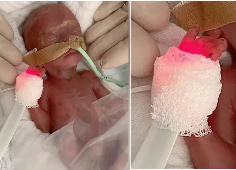 Una bebé en Alemania nació 16 semanas antes de la fecha prevista y con un peso de 300 gramos. FOTOS: Hospital Universitario de Magdeburgo