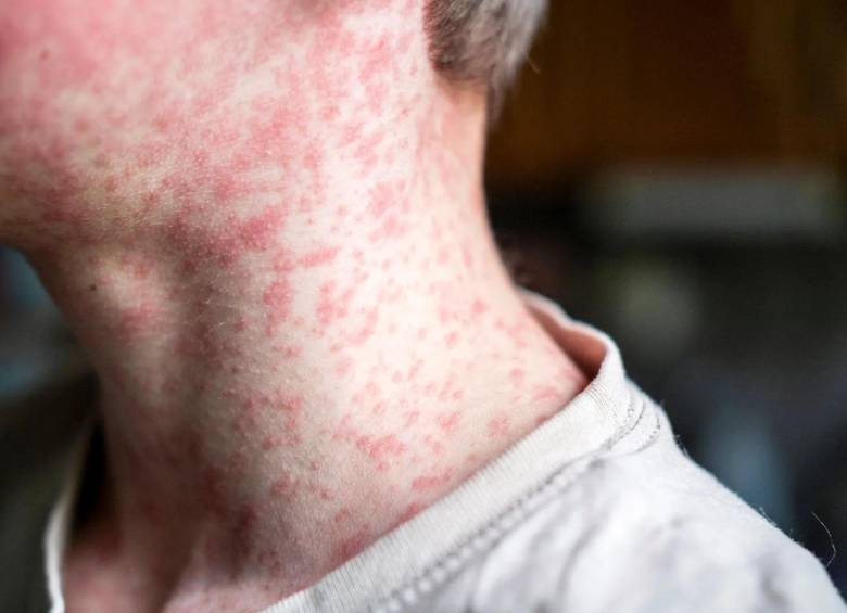 El virus del sarampión, altamente contagioso y potencialmente mortal para niños, ha encontrado en México su epicentro continental con más de 11.200 casos confirmados. FOTO: Getty