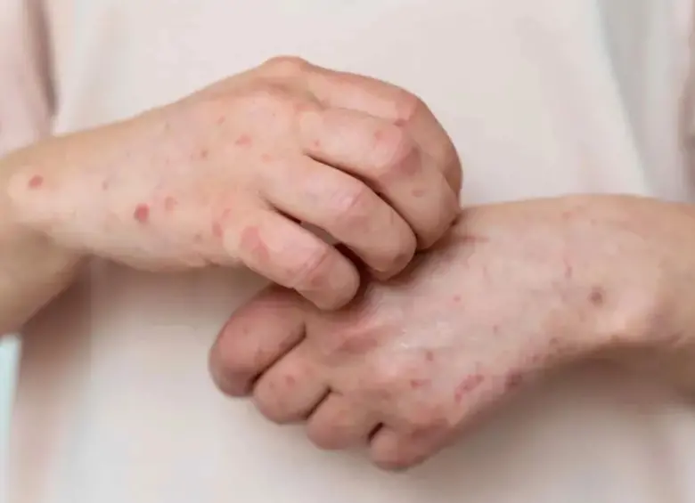 Lo que comenzó como un brote en el norte del país se ha convertido en la mayor crisis de sarampión del continente. FOTO: Freepik