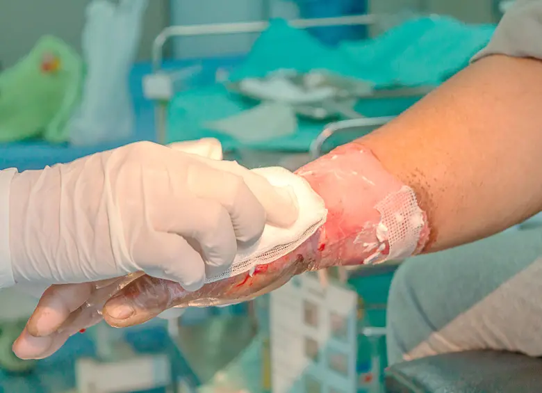 40 personas en Antioquia han sufrido lesiones grado 2 y 3, que implican en muchos casos daños irreversibles. FOTO: GETTY