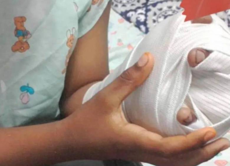 A la fecha, 74 menores han resultado quemados en lo que va de diciembre. Foto: Colprensa