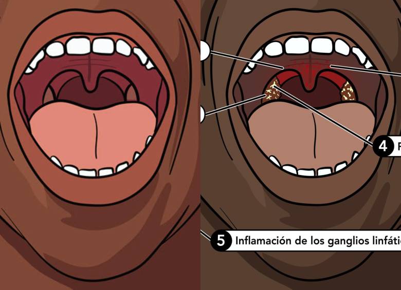 A la izquierda, el interior de una boca sana. En el lado derecho, el interior de una boca con bacteria de estreptococos del grupo A. FOTO: Imágenes tomadas de www.cdc.gov 