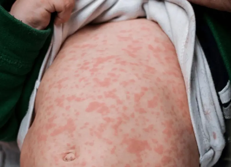 La vacunación masiva es la única barrera contra una epidemia de millones. FOTO: OPS