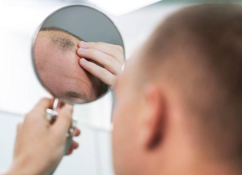 45 % de los hombres entre 35 y 60 años presentan algún tipo de alopecia. FOTO: FREEPIK