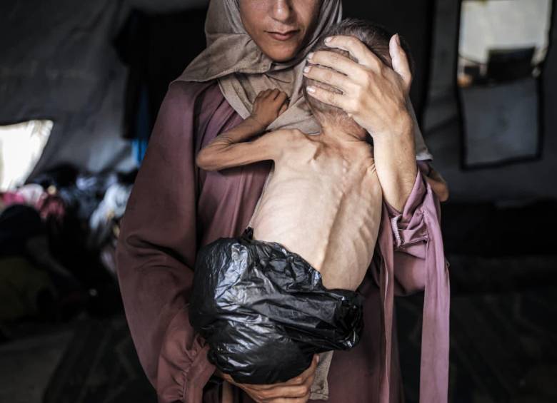 Muhammad Zakariya Ayyoub al-Matouq, un niño de un año y medio en la ciudad de Gaza, enfrenta una desnutrición que pone en peligro su vida a medida que la situación humanitaria empeora debido a los continuos ataques y bloqueos israelíes FOTO: Getty