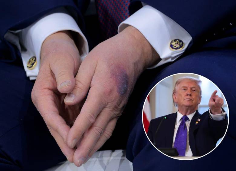 Los hematomas en la mano de Donald Trump que lo ponen bajo la lupa en redes sociales. Fotos: Getty Images 