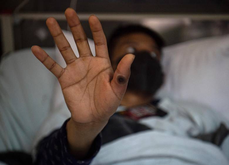 Los hombres entre los 30 y los 39 años son los más afectados por este virus en Colombia. FOTO AFP