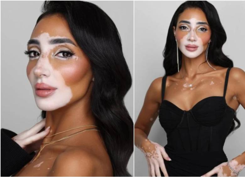 En un renovado certamen de Miss Universo, la modelo egipcia Logina Salah será la primera participante con vitiligo en este reinado mundial de belleza. FOTO: REDES SOCIALES DE LOGINA SALAH