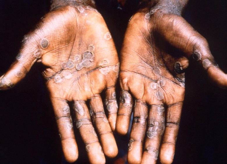 Hasta ahora van 55 casos reportados en Colombia. Aunque no es tan contagioso como la covid-19, no baje la guardia. FOTO: GETTY