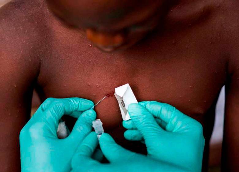 La enfermedad se detectó por primera vez en 1970 en la República Democrática del Congo. FOTO: GETTY