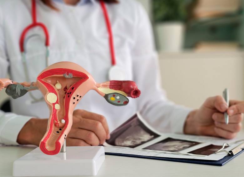 En 1860 se documentó el primer caso de endometriosis en el mundo. Foto Getty.