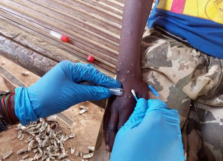 A pesar de la reciente propagación en África de la variante más peligrosa, clado 1b, el virus encontrado en Pakistán no está relacionado con esta nueva cepa. FOTO: OMS