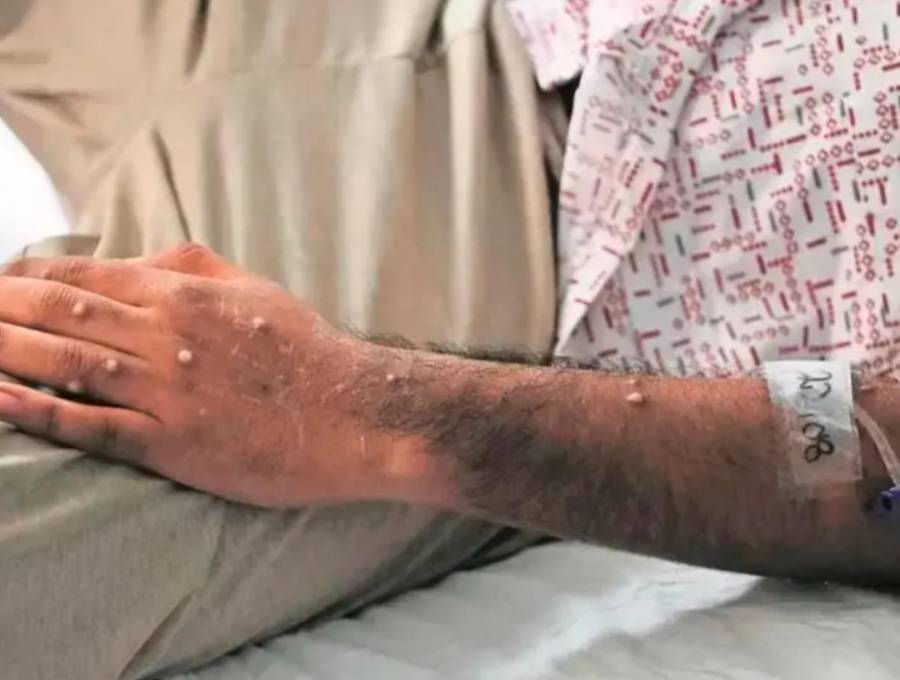 Las llagas aparecen entre uno y cinco días después de los primeros síntomas. FOTO CORTESÍA OMS.