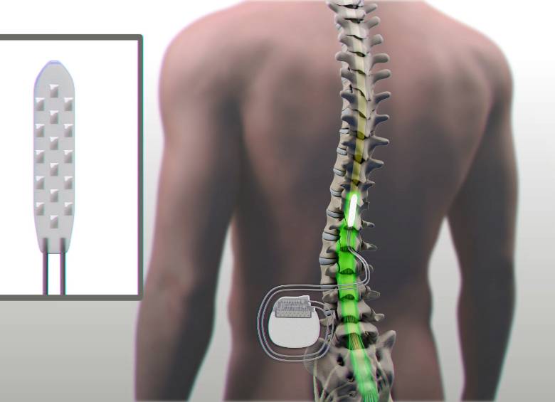 Parapléjico logra caminar bajo estimulación eléctrica