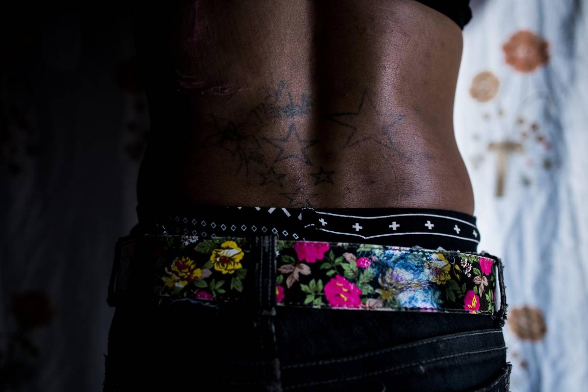 Cicatrices y tatuajes en varias partes del cuerpo revelan lo que ha vivido Timona, mujer trans de El Carmen de Bolívar. Un hombre casi la mata hace más de 4 meses. Foto: Charlie Cordero 