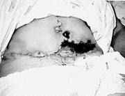A Doris la abdominoplastia le destrozo tejido y le dejó cicatrices profundas.