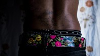 Cicatrices y tatuajes en varias partes del cuerpo revelan lo que ha vivido Timona, mujer trans de El Carmen de Bolívar. Un hombre casi la mata hace más de 4 meses. Foto: Charlie Cordero 