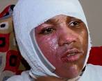 Kyland Clark, de 15 años, tuvo quemaduras de segundo grado por el reto viral ‘Hot Water Challenge’. Foto: Fox59