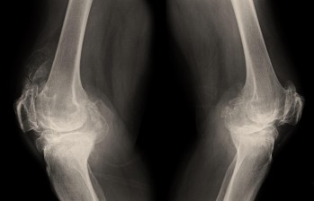 Aunque frecuente en mujeres de edad adulta, la osteoporosis también pueden padecerla los hombres. FOTO sstock