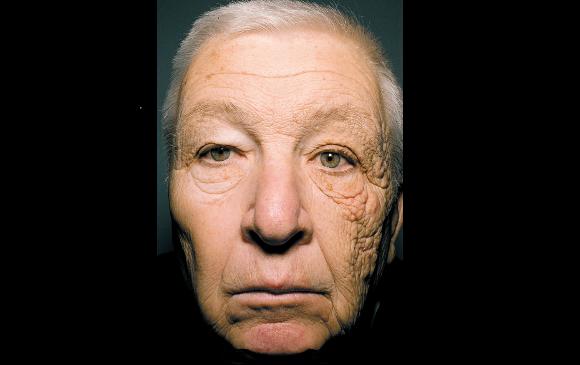 El hombre de la imagen fue tratado con retinoides tópicos, le recomendaron revisiones periódicas de la piel y el uso de protección solar. Foto: www.nejm.org