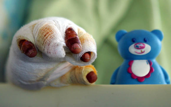 Al 10 de diciembre iban 135 quemados en el país. FOTO colprensa