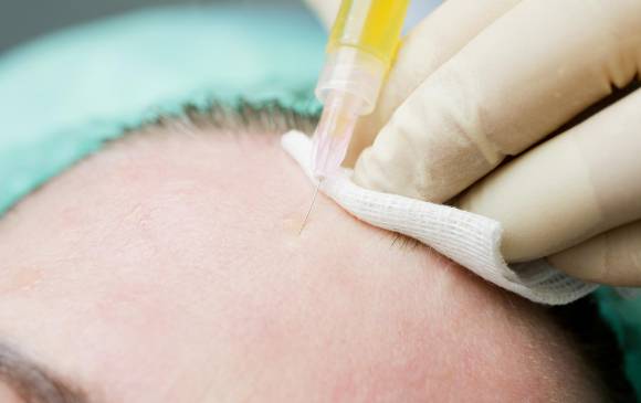 Su sangre podría estimular el crecimiento de su pelo
