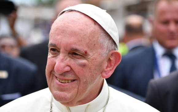 Así quedó el Papa Francisco luego del golpe con el papamóvil. FOTO AFP