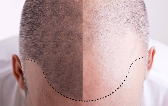 Su sangre podría estimular el crecimiento de su pelo
