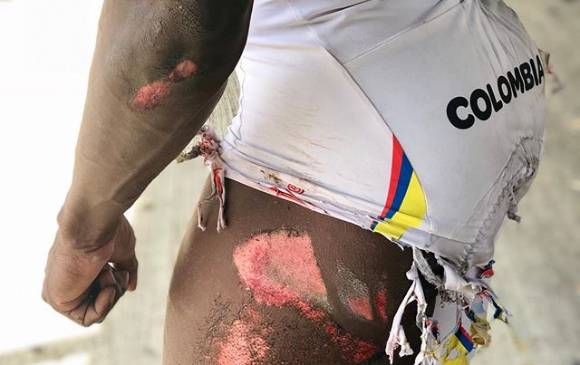 A pesar de los golpes que se evidencian en su cuerpo, el corredor colombiano, Rubén Darío Murillo está listo para iniciar este miércoles la participación de Colombia en el Mundial de pista. FOTO TOMADA DE TWITTER 