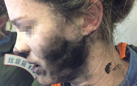 A la mujer también se le quemó el pelo a causa del fuego que provocaron los audífonos FOTO: AFP