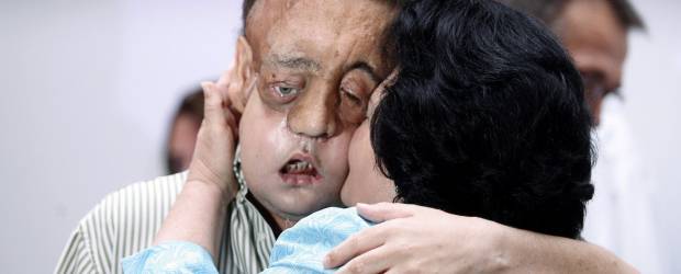 Primera aparición en público el segundo hombre trasplantado de cara en España | Reuters | El joven, según los médicos, ha ido recuperando su vida. Los médicos destacaron su capacidad de recuperación. En la foto, aparece con Juana, su mamá.