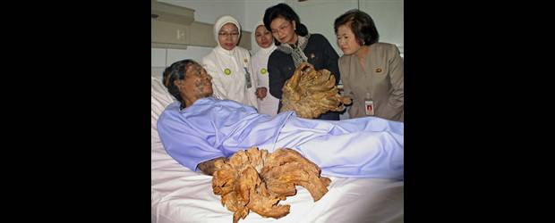 Catastrófica es la atención | Cortesía del Dr. Jesús Vásque | Imagen de un hombre árbol. Paciente de enfermedades raras o huérfanas.