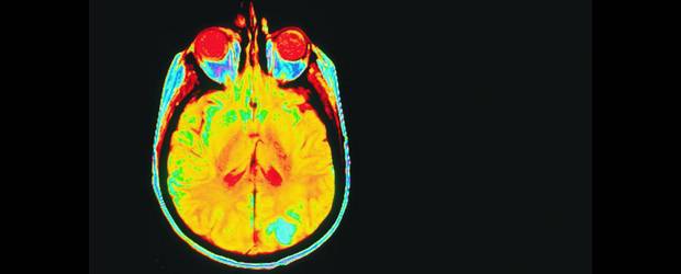 La guerra frontal contra el cáncer | Cortesía Nci | A la fecha se ha publicado el genoma de 75 tipos de cáncer. En la foto, la mancha azul inferior indica cáncer en el cerebro. En la foto de la derecha un cáncer de seno.