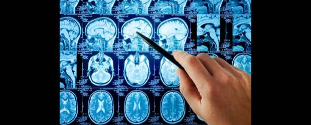 Cambiar de hígado mejora el cerebro | Shutterstock | La investigación se realizó en 21 pacientes.